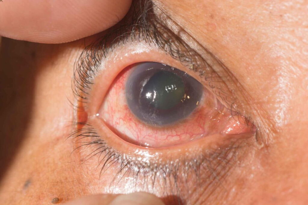 eye test glaucoma