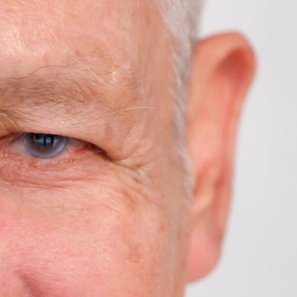 symptoms of glaucoma