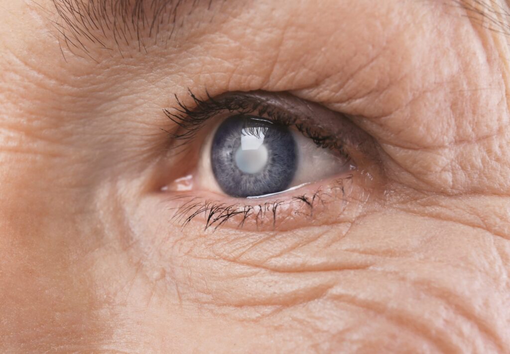 symptoms of glaucoma